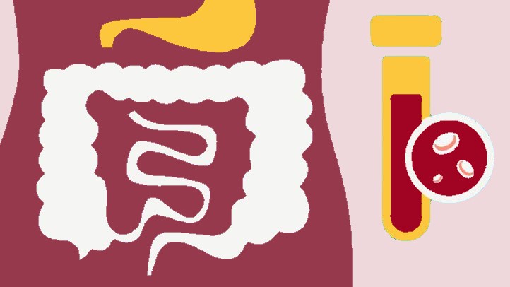 Efficacy and Tolerability of Oral Iron Protein Succinylate in the Treatment of Iron Deficiency Anemia in Adults with Gastrointestinal Diseases
